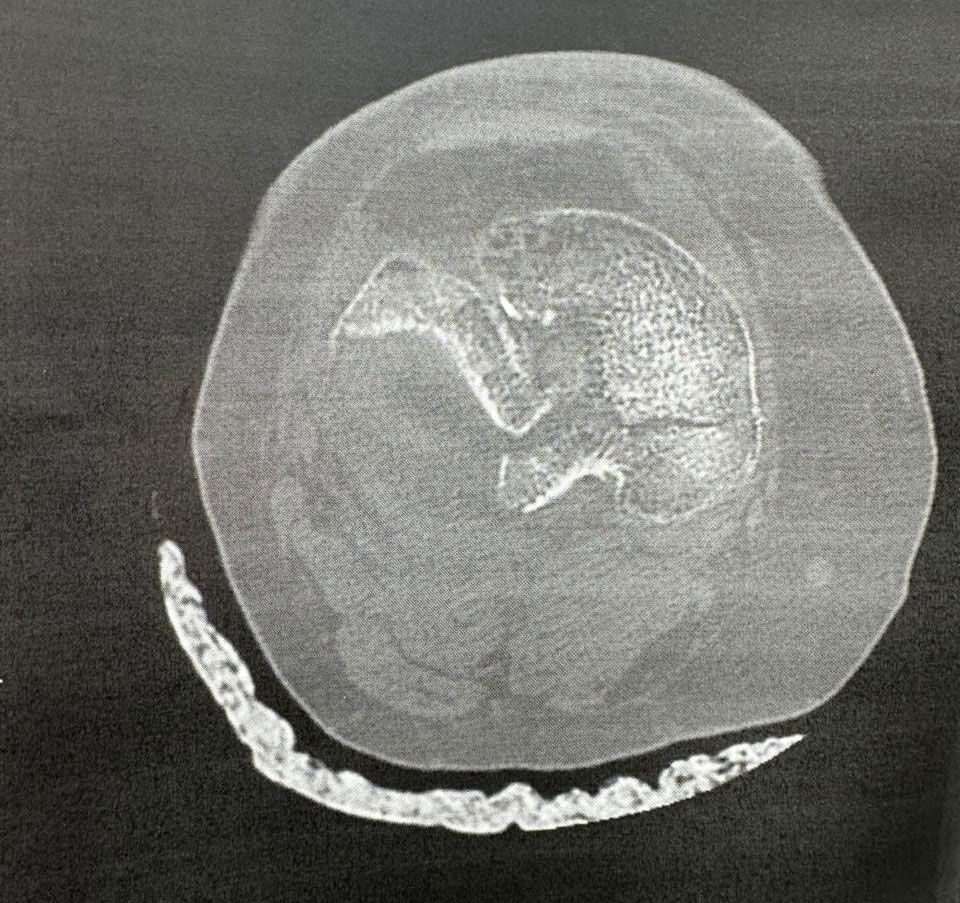 Pre-operative imaging of tibial plateau fracture (view 2)