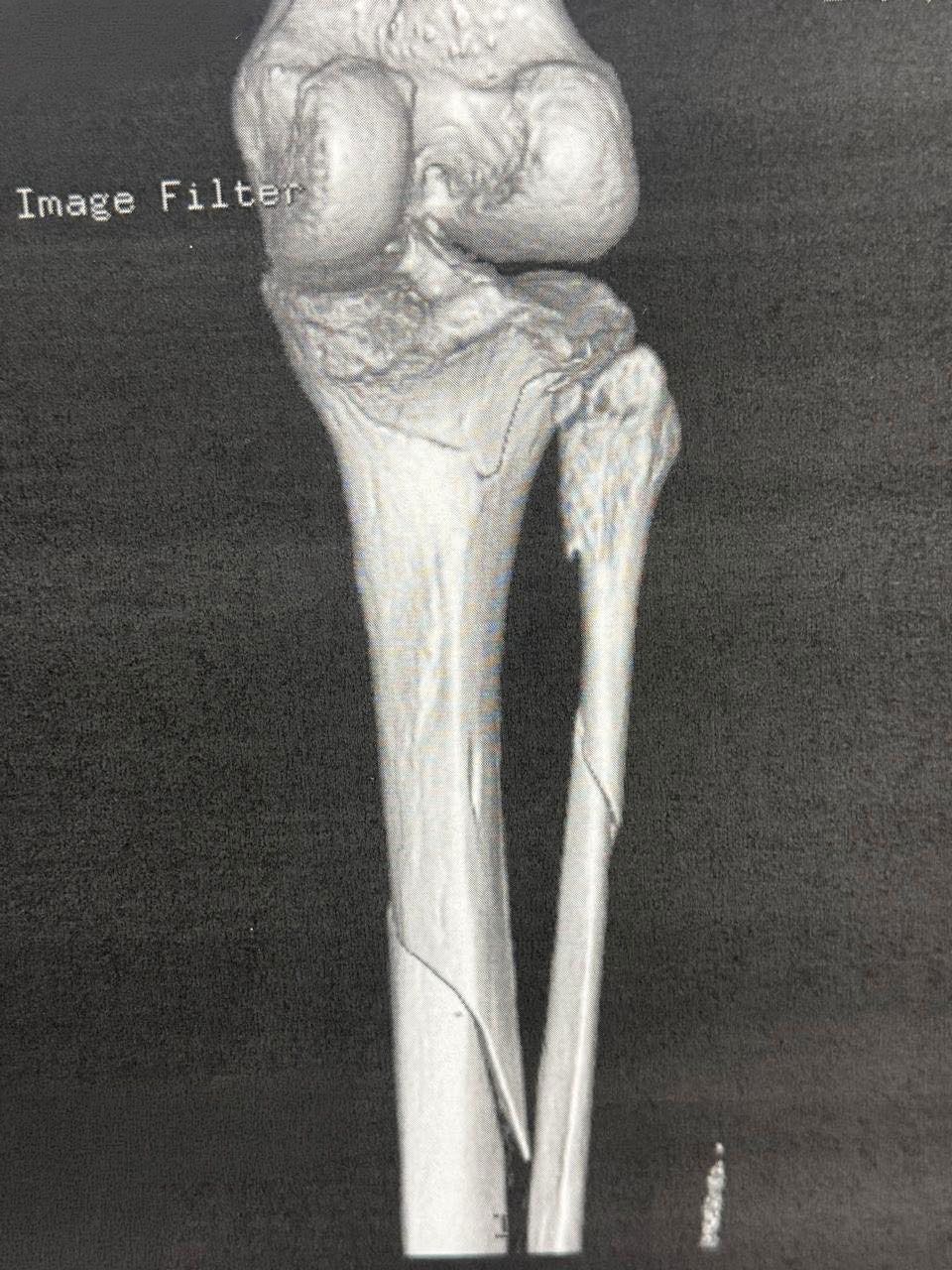 Pre-operative imaging of tibial plateau fracture (view 3)
