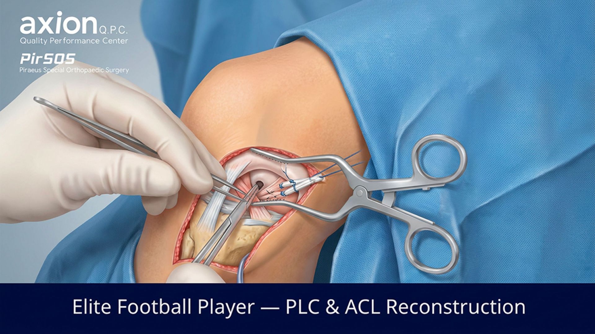 Illustration of intra-operative knee surgery showing PLC and ACL reconstruction in an elite football