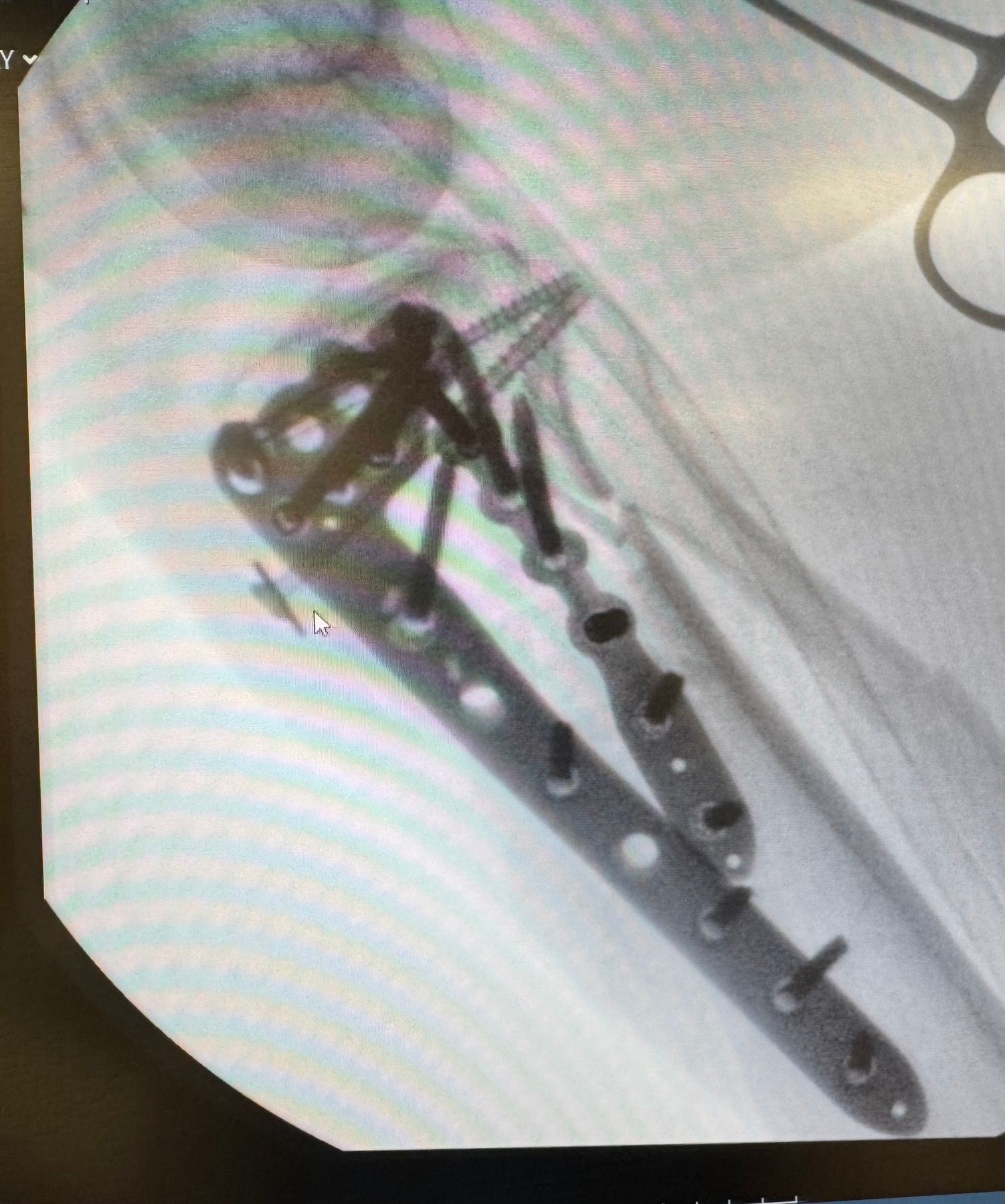 Μετά το χειρουργείο – απεικόνιση αποτελέσματος αποκατάστασης κατάγματος κνημιαίου πλατώ 2