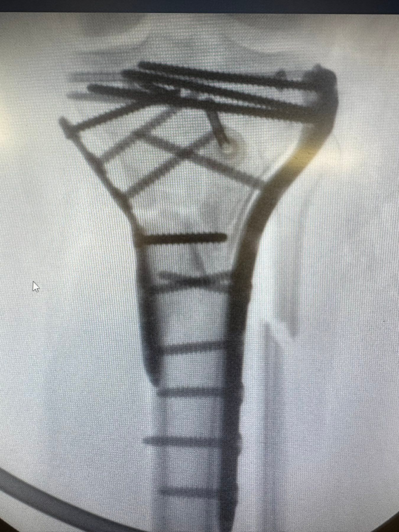 Μετά το χειρουργείο – απεικόνιση αποτελέσματος αποκατάστασης κατάγματος κνημιαίου πλατώ 1
