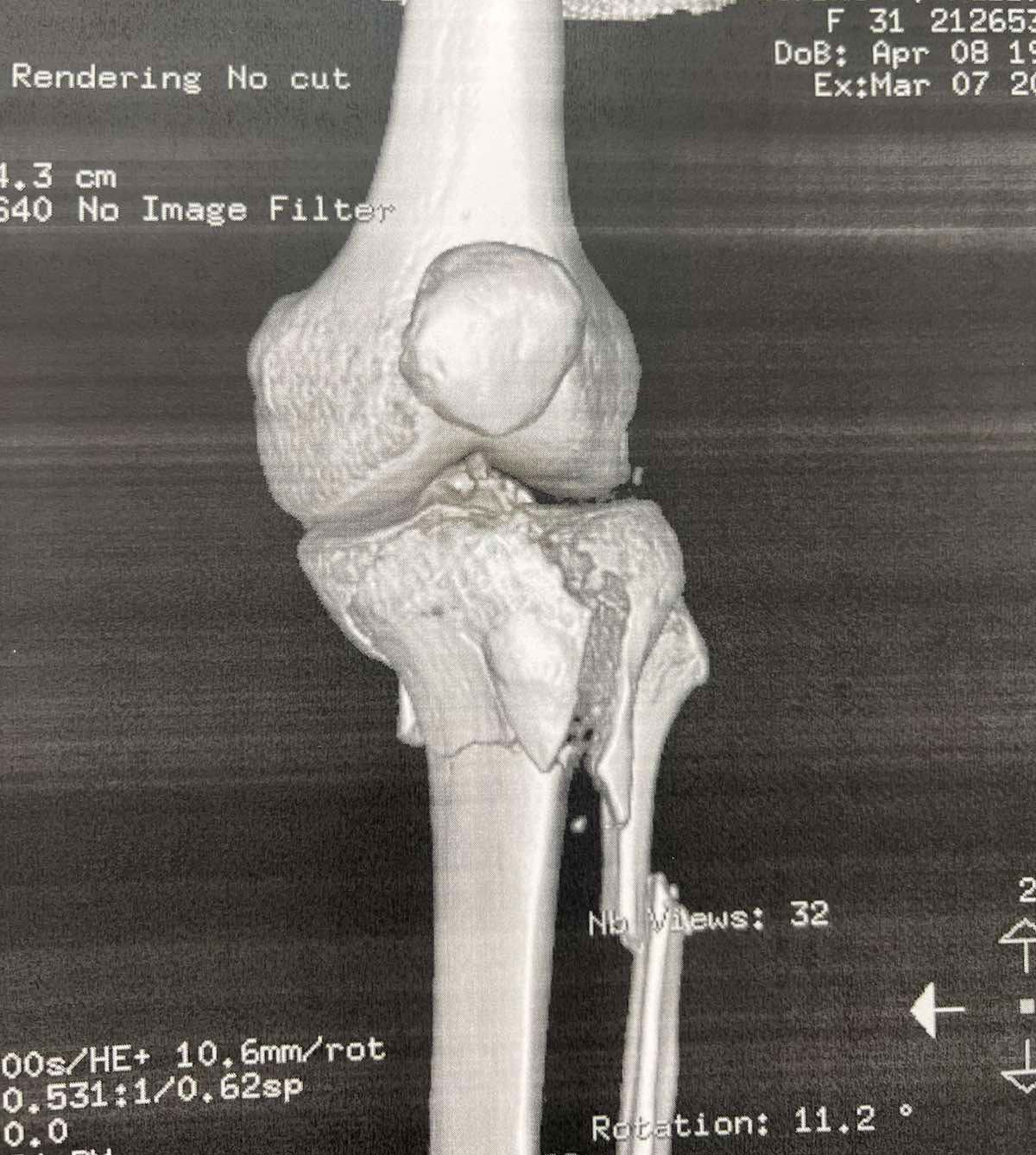 Πριν το χειρουργείο – απεικόνιση κατάγματος κνημιαίου πλατώ (Schatzker VI) 1