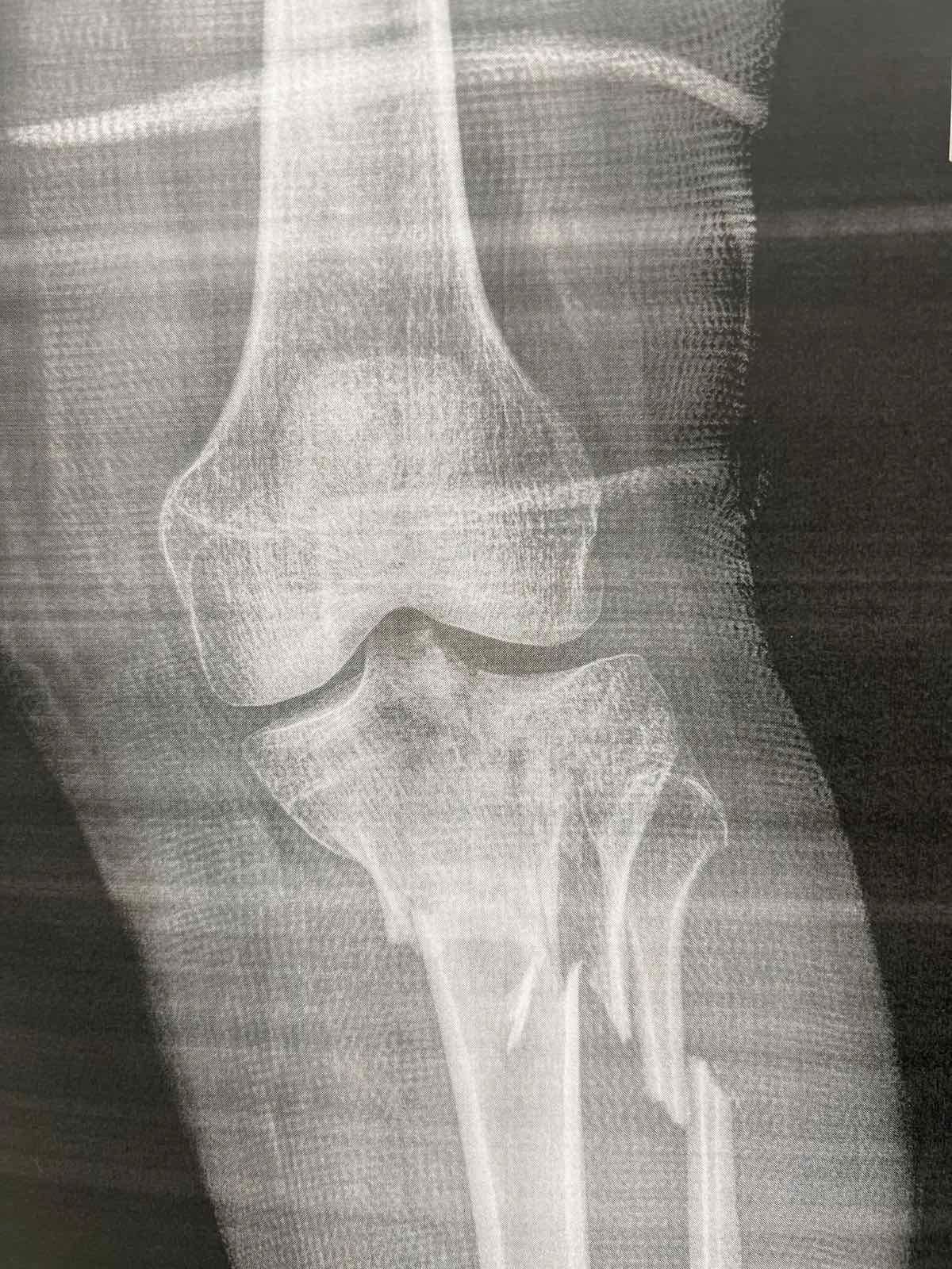 Πριν το χειρουργείο – απεικόνιση κατάγματος κνημιαίου πλατώ (Schatzker VI) 8