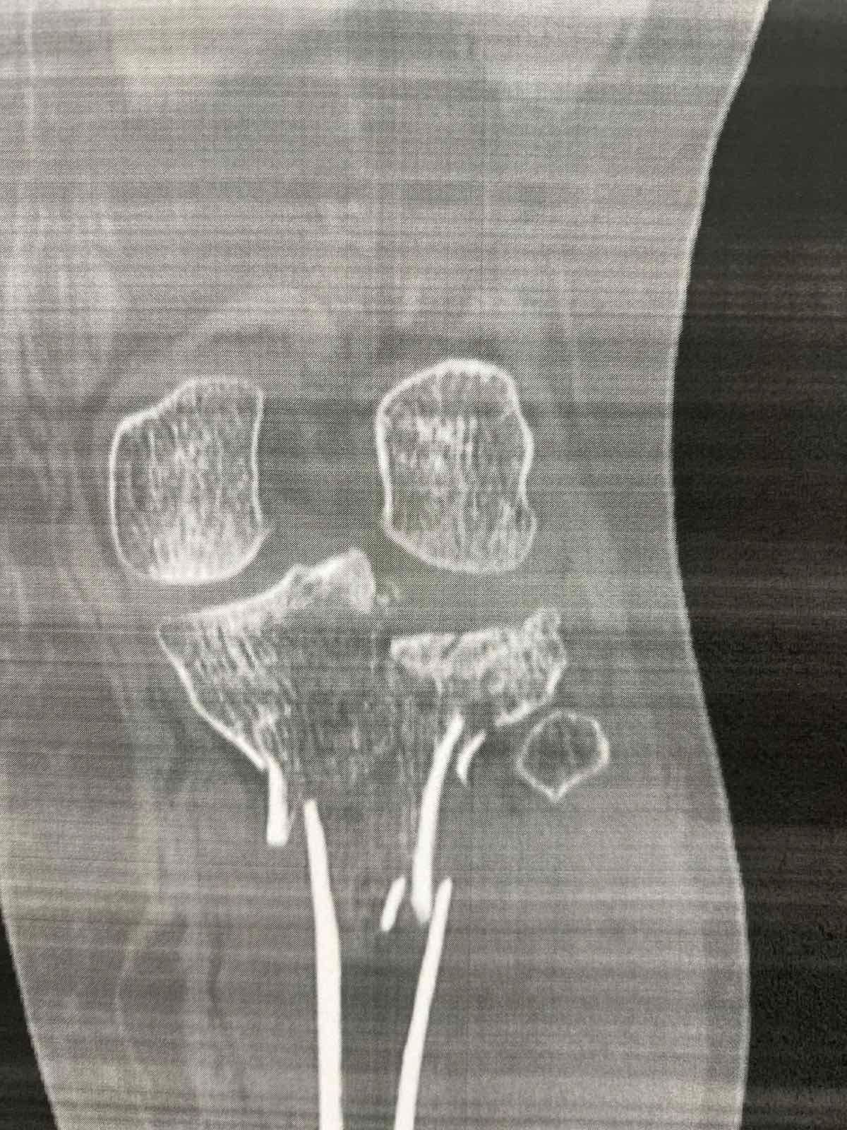 Πριν το χειρουργείο – απεικόνιση κατάγματος κνημιαίου πλατώ (Schatzker VI) 7