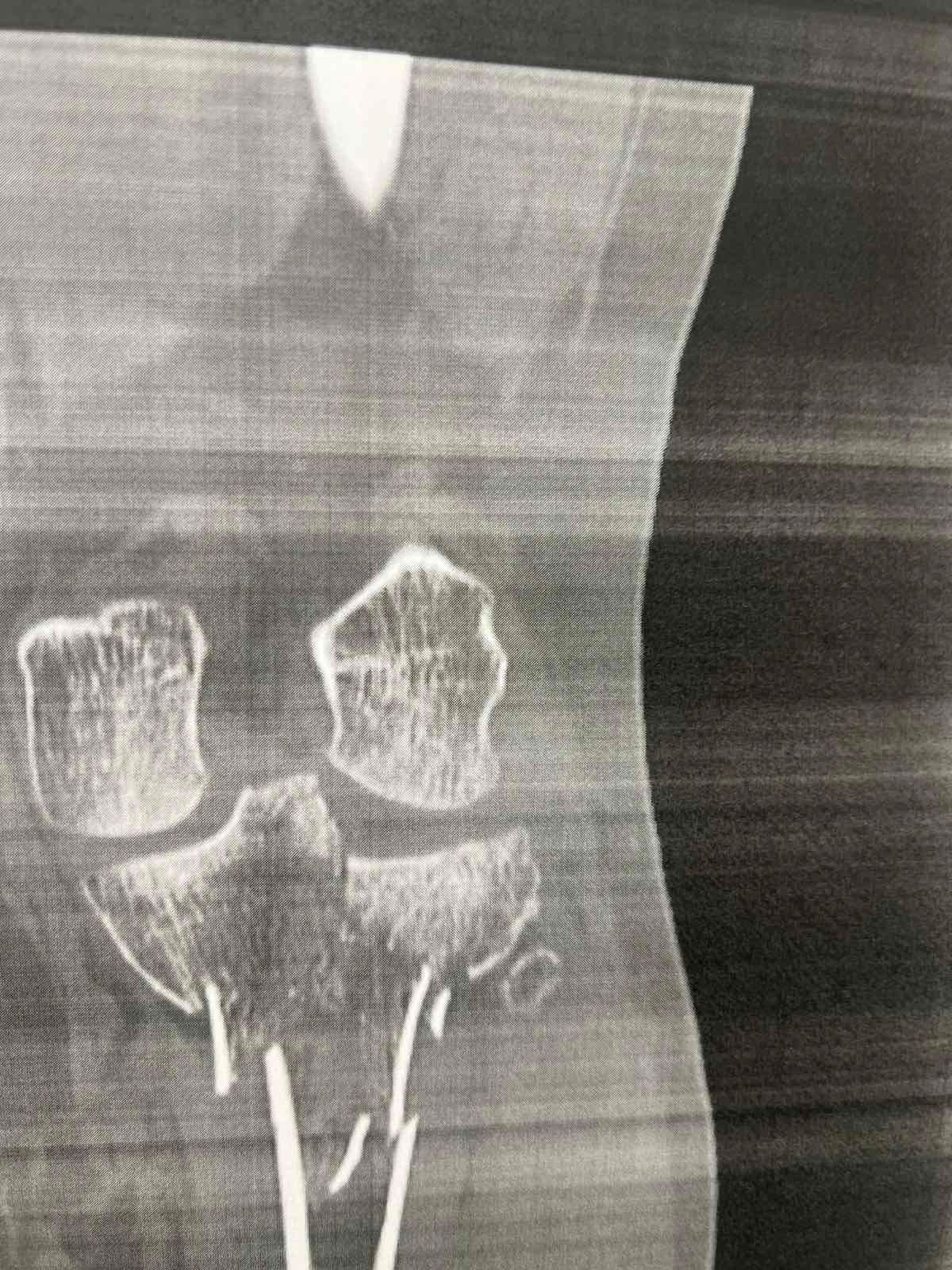 Πριν το χειρουργείο – απεικόνιση κατάγματος κνημιαίου πλατώ (Schatzker VI) 6