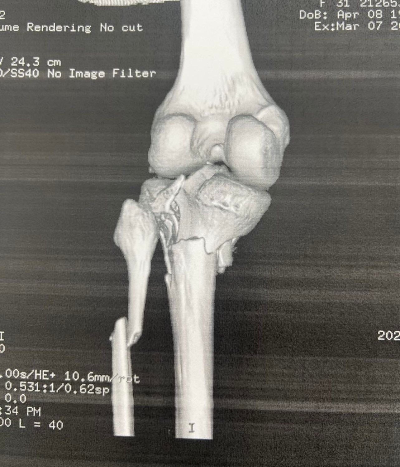 Πριν το χειρουργείο – απεικόνιση κατάγματος κνημιαίου πλατώ (Schatzker VI) 5