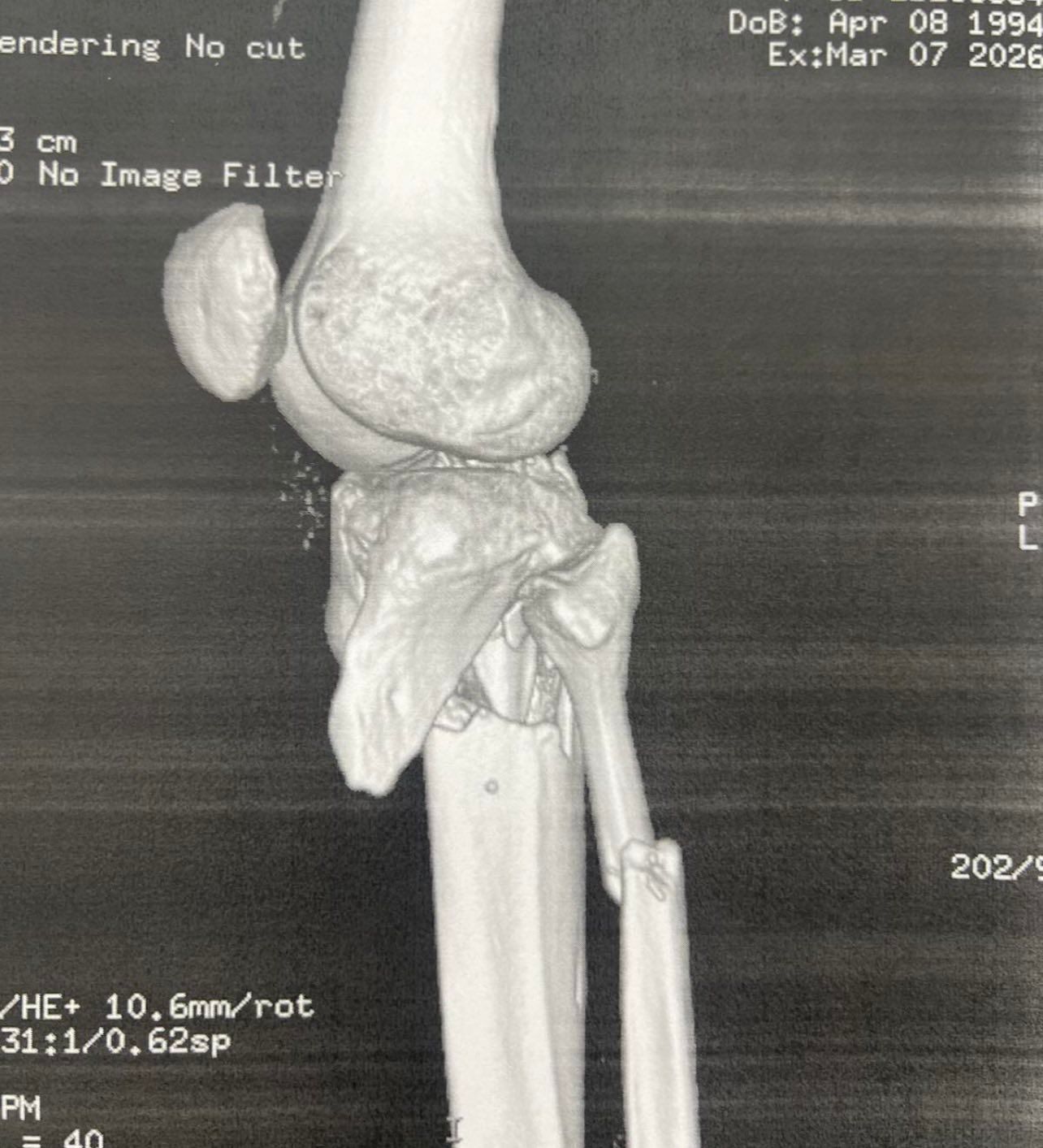 Πριν το χειρουργείο – απεικόνιση κατάγματος κνημιαίου πλατώ (Schatzker VI) 4