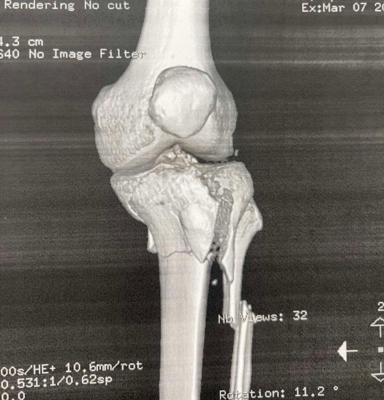 Πριν το χειρουργείο – απεικόνιση κατάγματος κνημιαίου πλατώ (Schatzker VI) 3