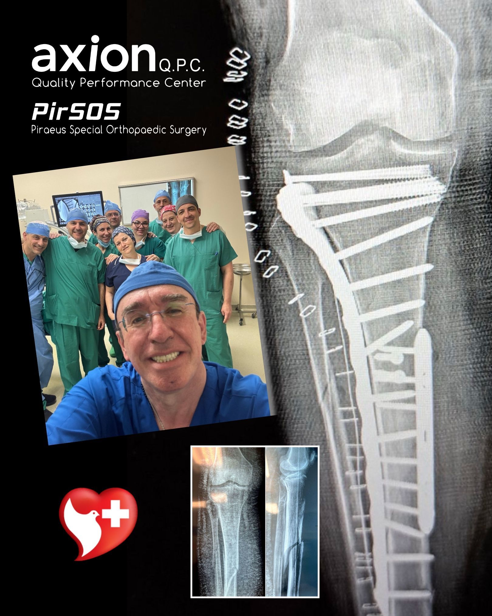 Collage with surgical team photo and knee X-ray showing tibial plateau fracture fixation (Axion Q.P.