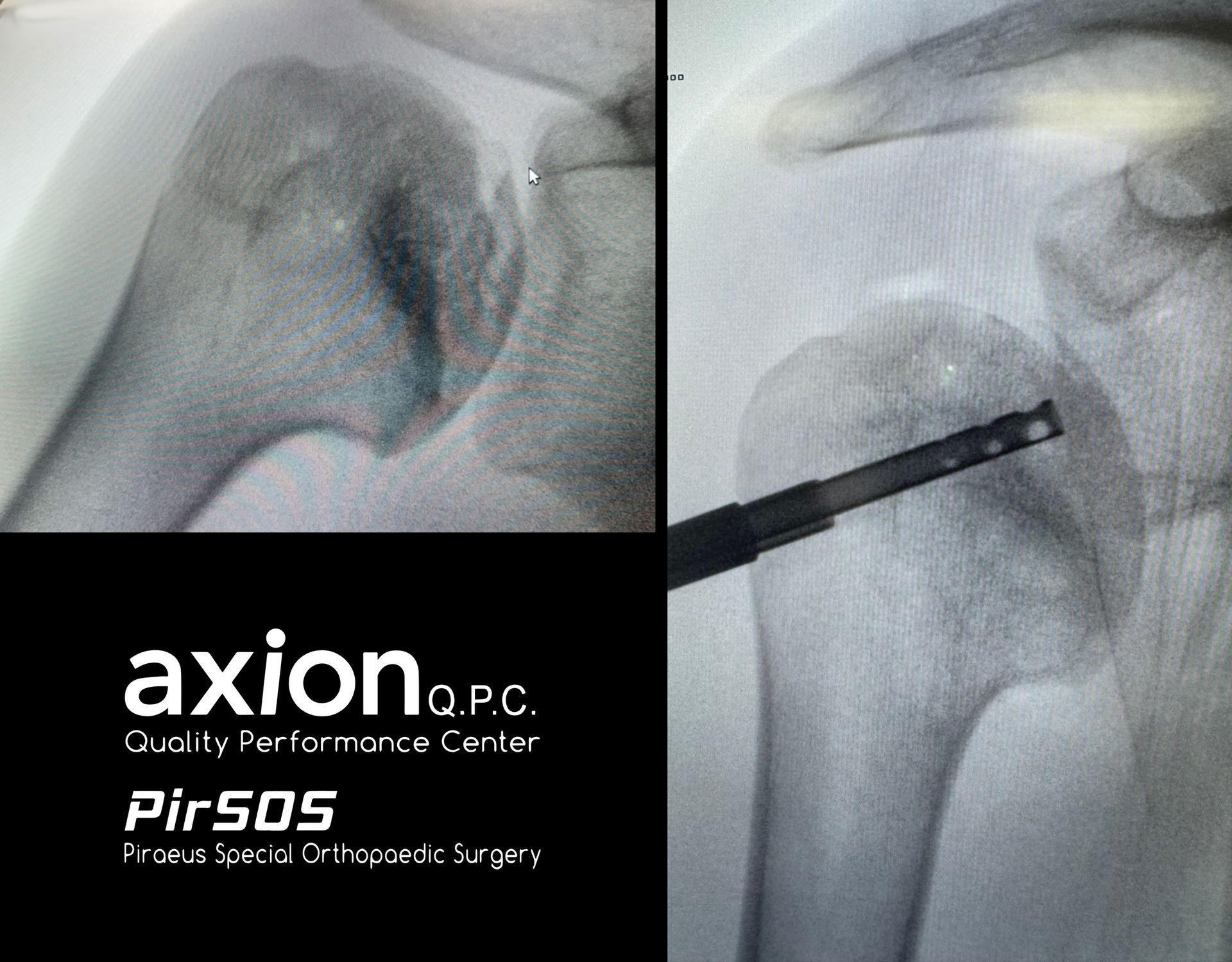 Pre-operative MRI imaging showing grade 3 osteonecrosis of the right humeral head with fissuration a