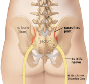 Fig. 1. The sacroiliac joints connect the base of the spine (sacrum) to the hip bones (ilium).