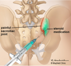 Figure 2. A needle is gently guided into the sacroiliac joint using x-ray fluoroscopy. An anesthetic and corticosteroid mixture (green) is injected into the inflamed joint.