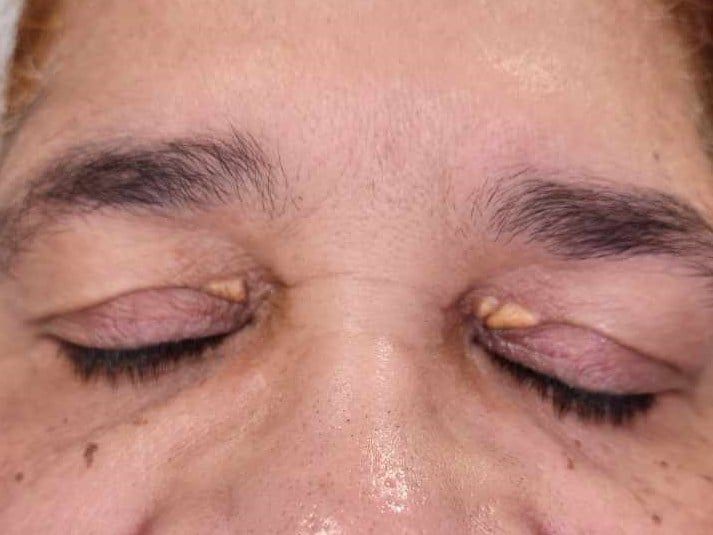 Before Eye Lid Skin Resurfacing