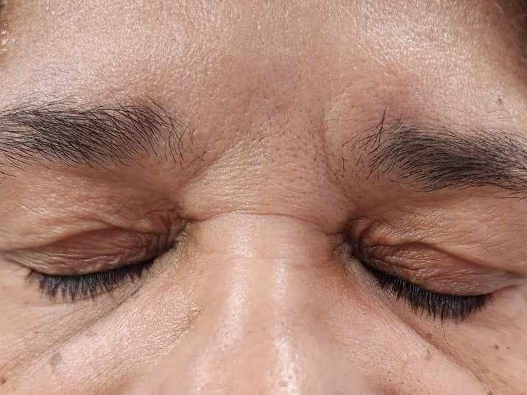 After Eye Lid Skin Resurfacing