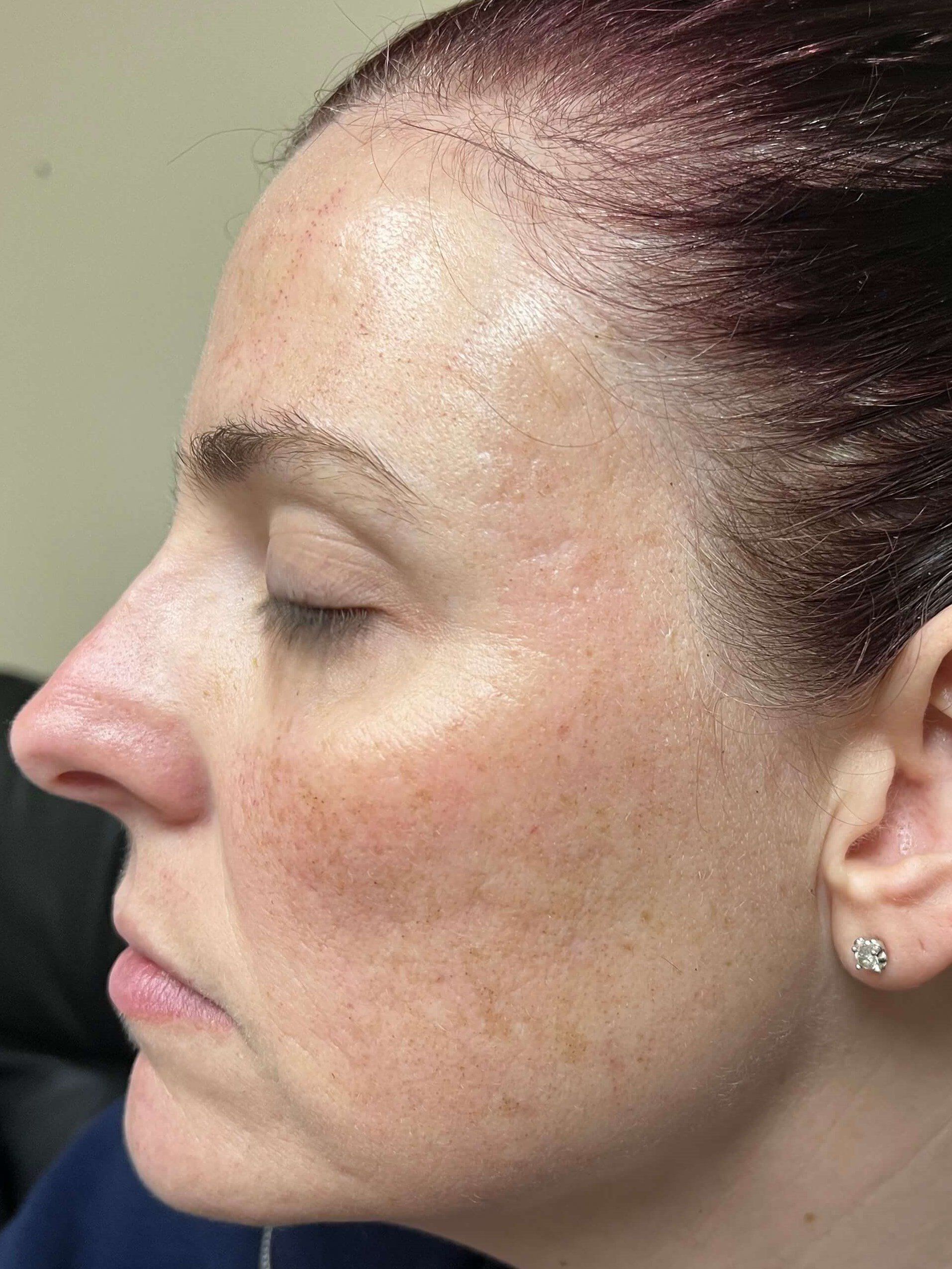 After Pimple Marks Skin Resurfacing