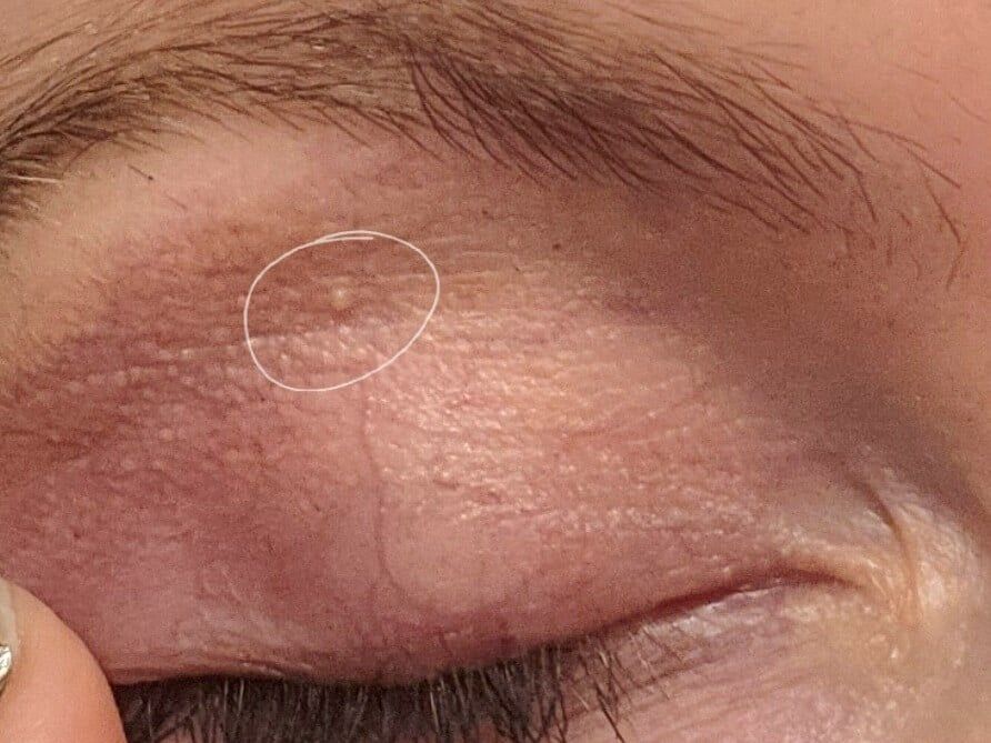 Before Milia Removal