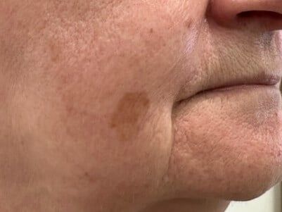 Before Old Woman Skin Resurfacing