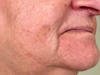 After Old Woman Skin Resurfacing