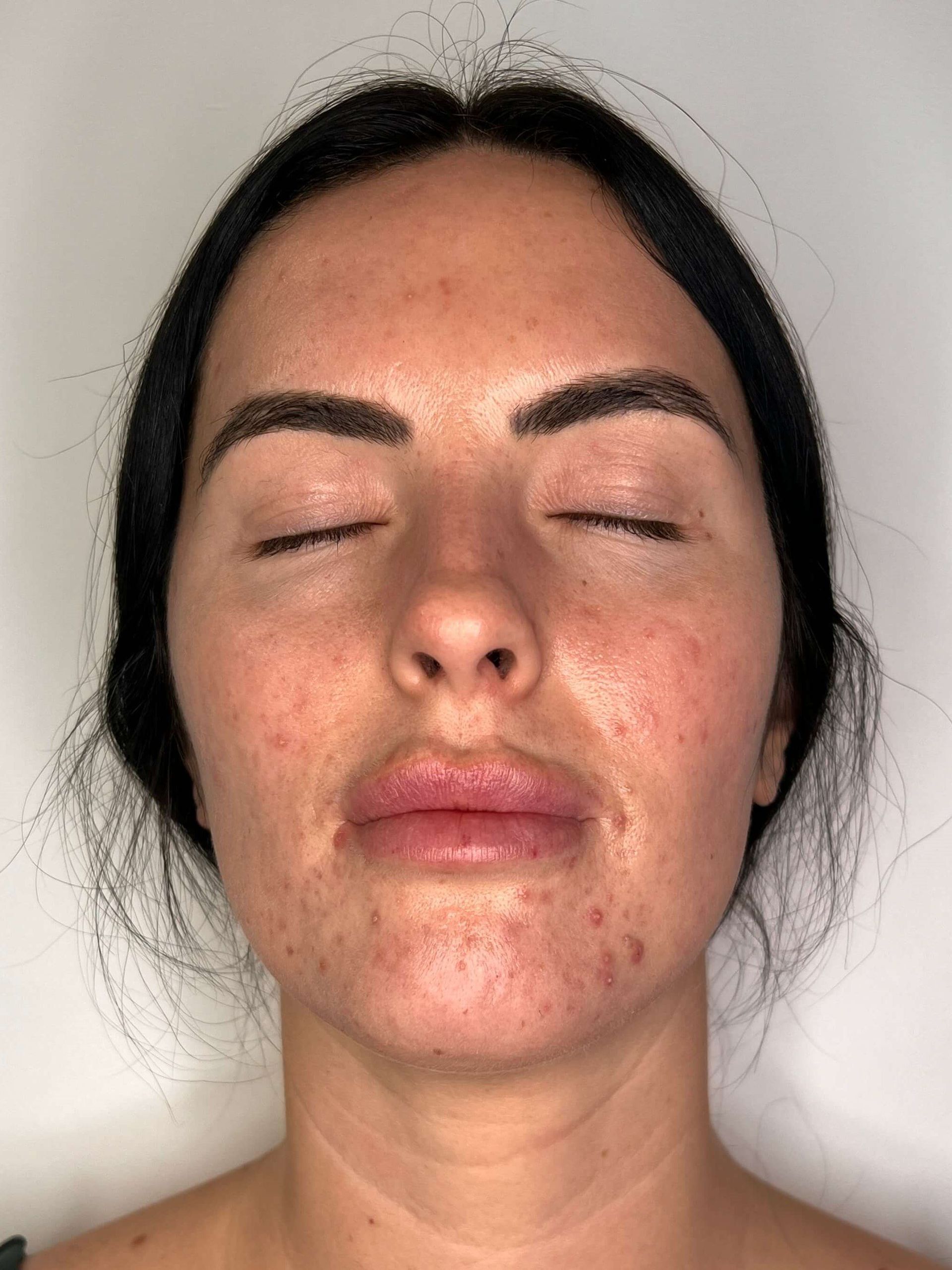 Before Pimple Skin Resurfacing