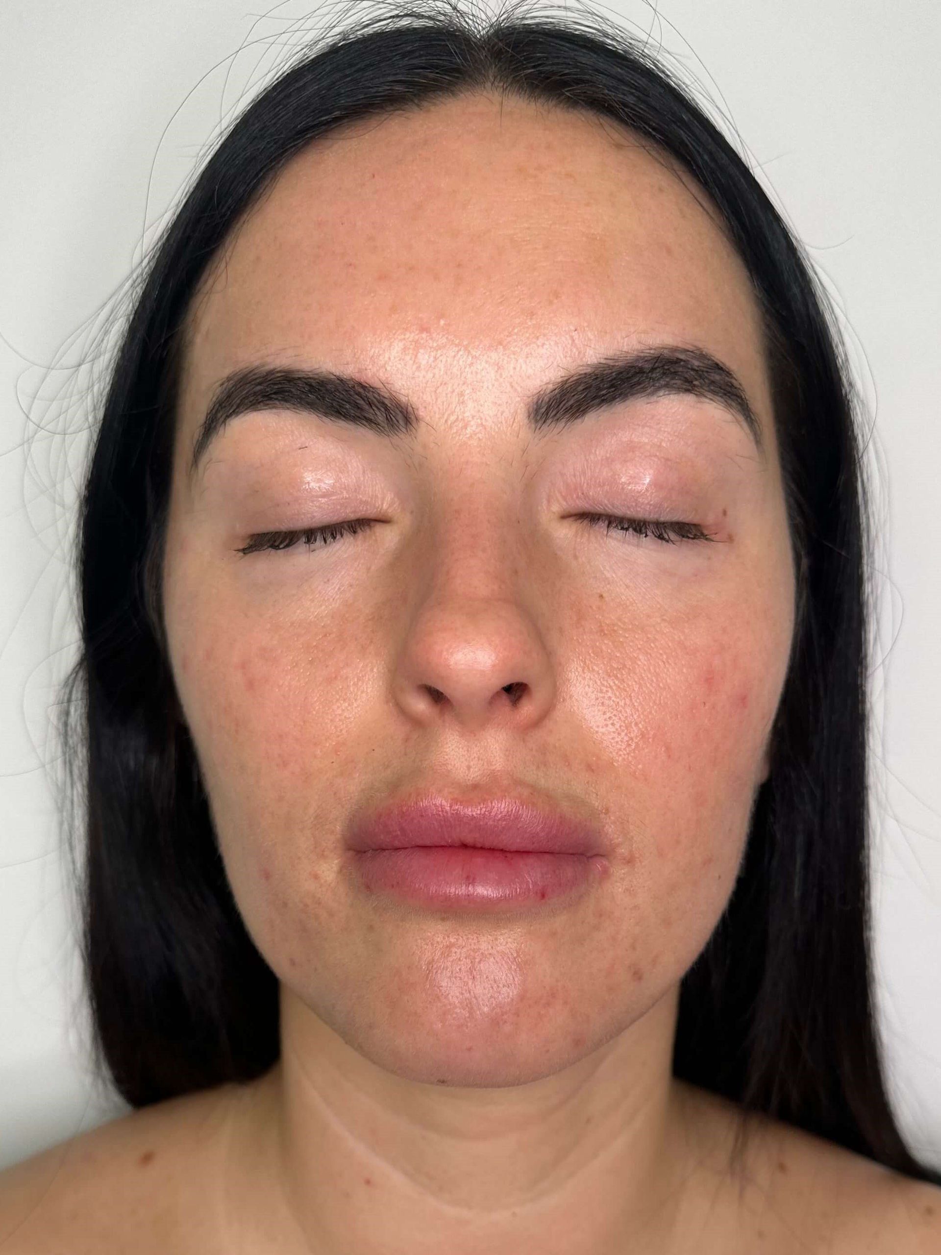 After Pimple Skin Resurfacing