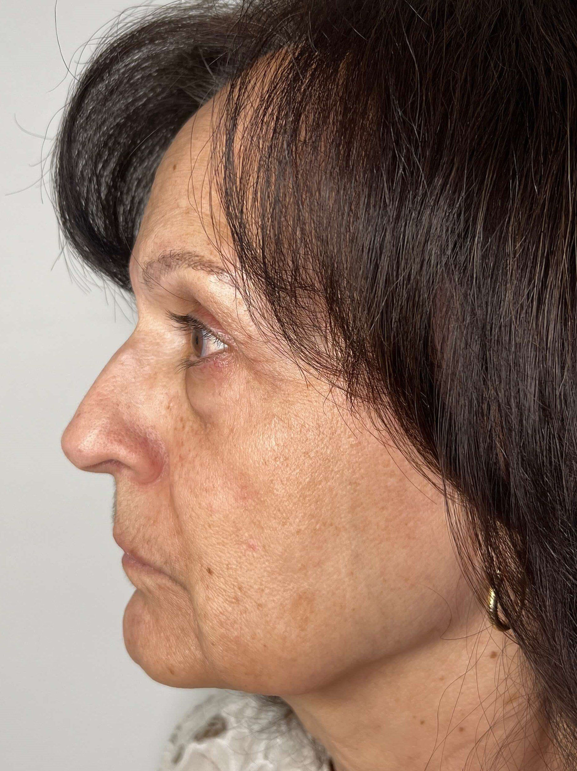 Before Eye Bag Skin Resurfacing