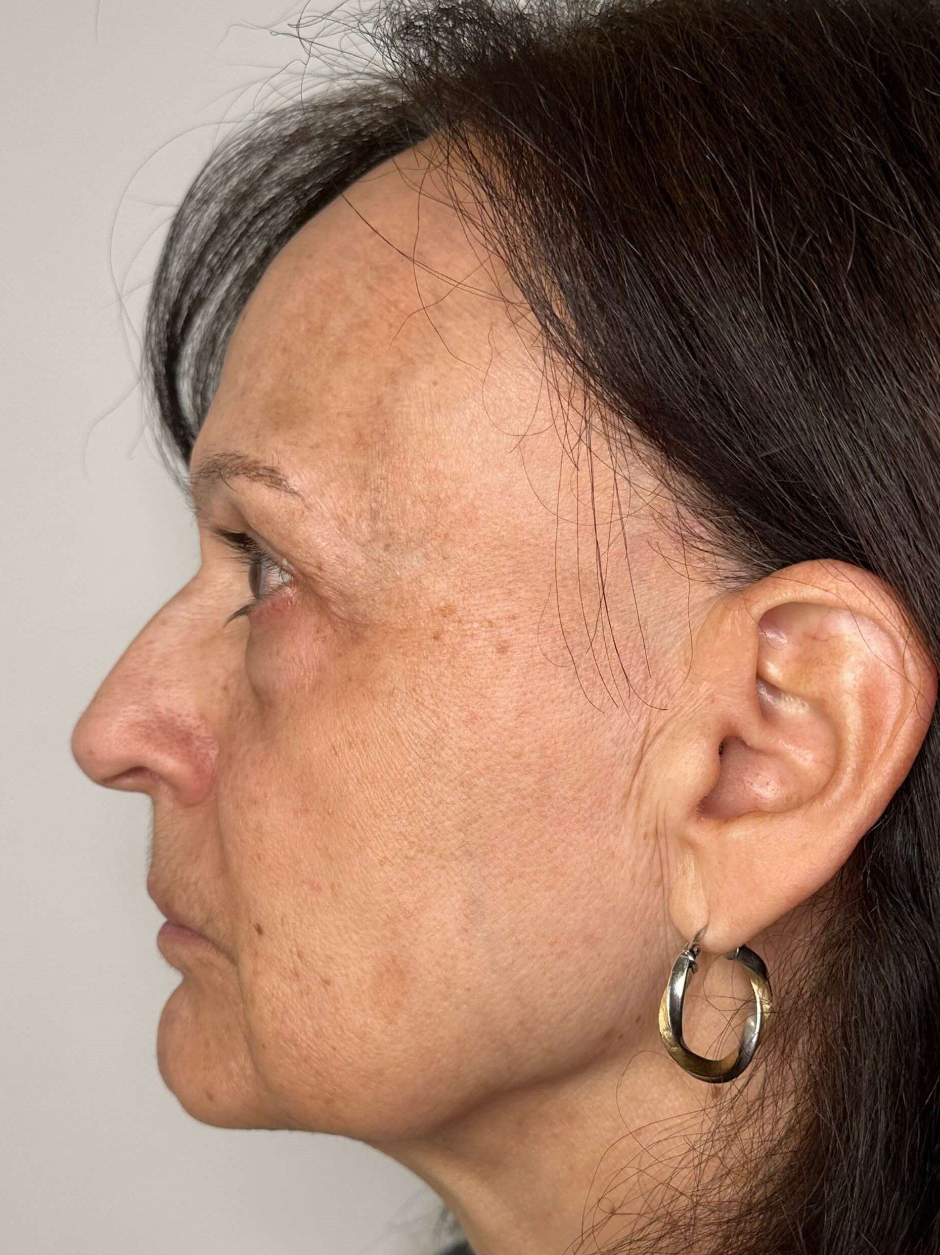 After Eye Bag Skin Resurfacing