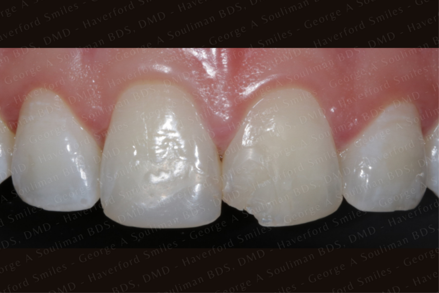 Front composite bonding before