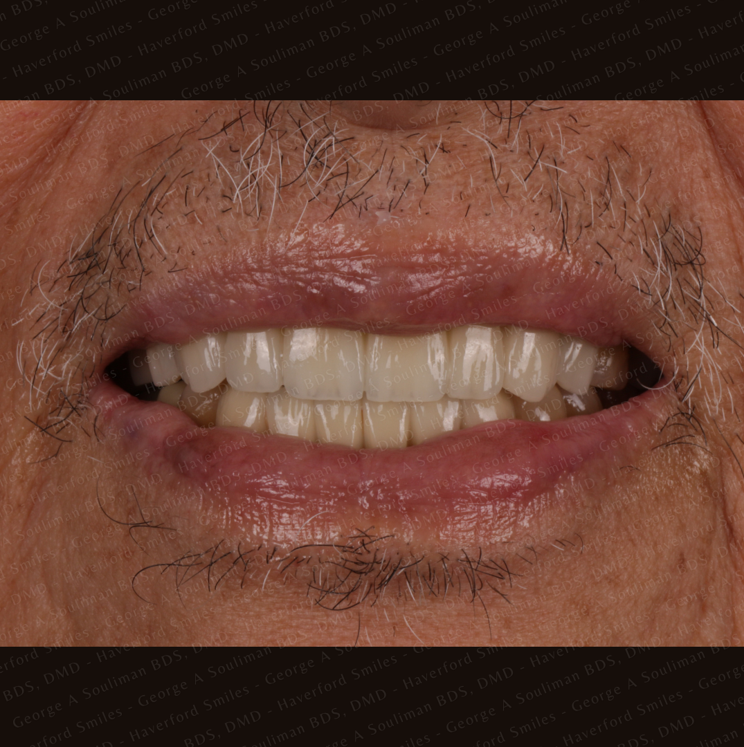 Anterior mouth Rehabilitation - Upper and Lower Bridgework after