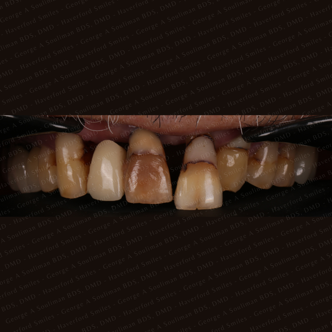 Anterior mouth Rehabilitation - Upper and Lower Bridgework before