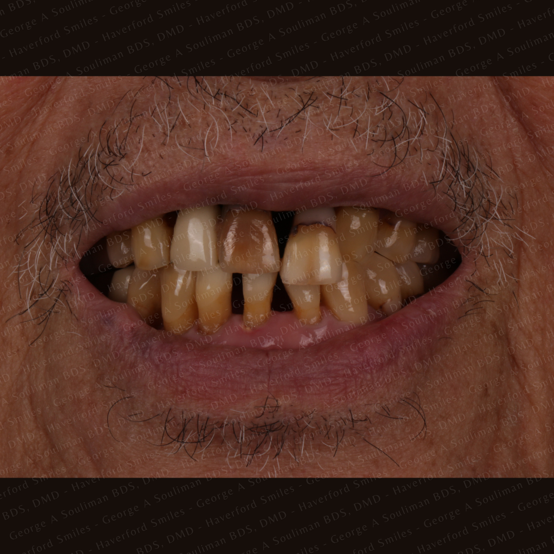 Anterior mouth Rehabilitation - Upper and Lower Bridgework before