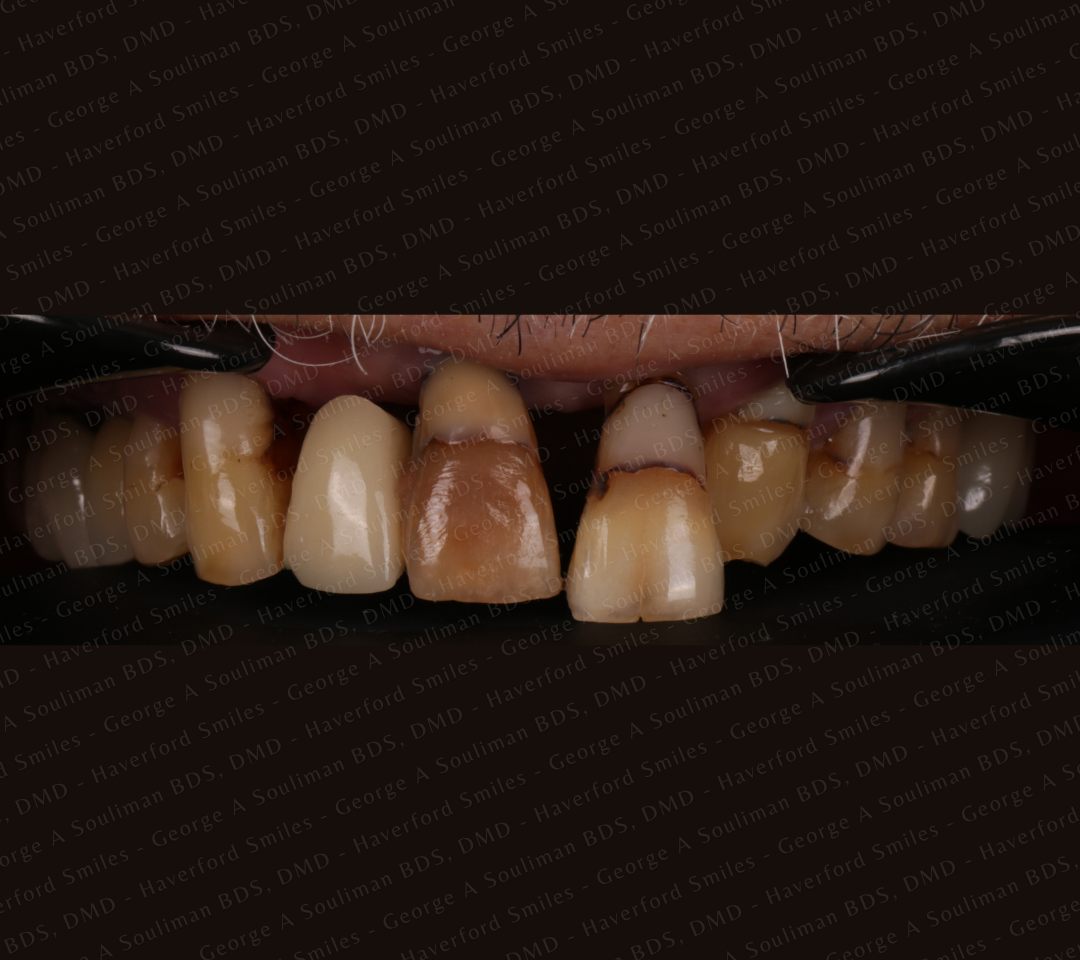 Anterior mouth Rehabilitation - Upper and Lower Bridgework before