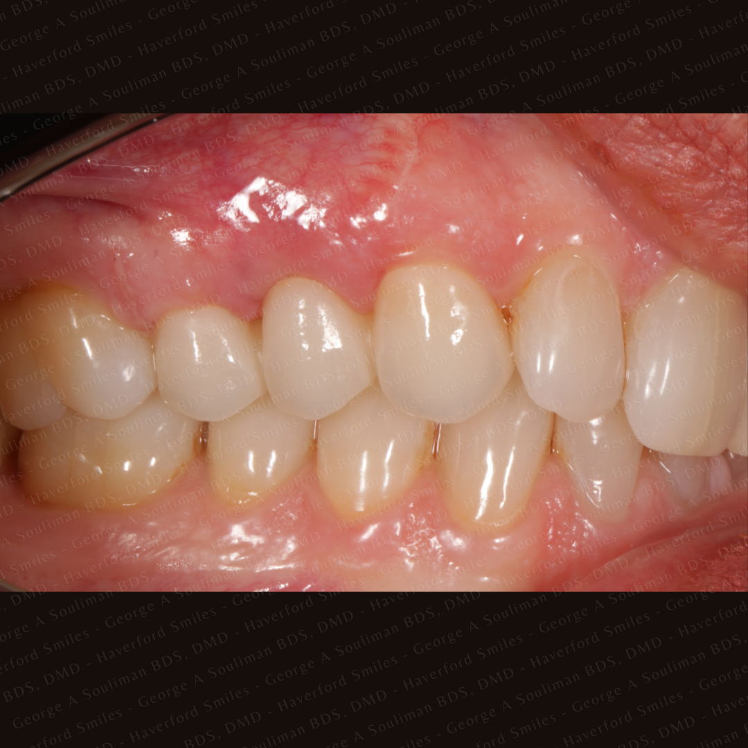 Cosmetic Ceramic Bridge After