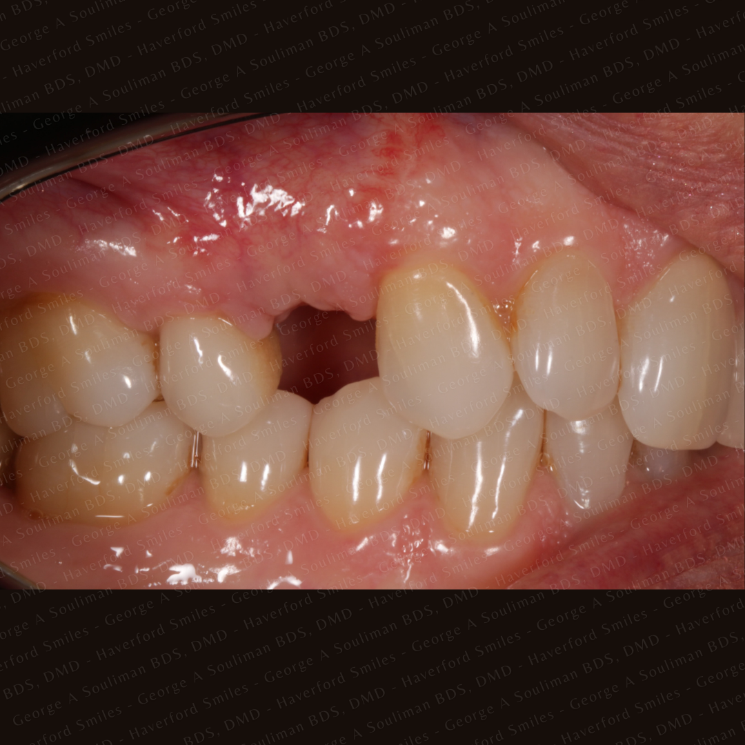 Cosmetic Ceramic Bridge Before