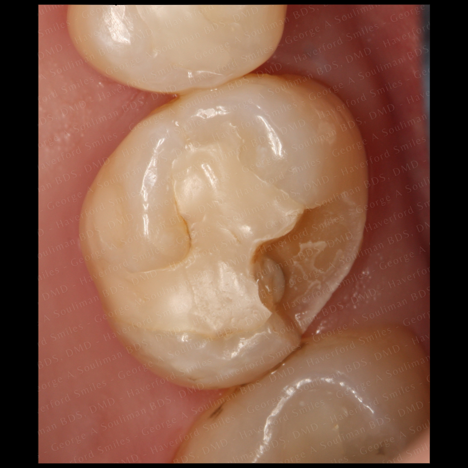 Ceramic Onlay before