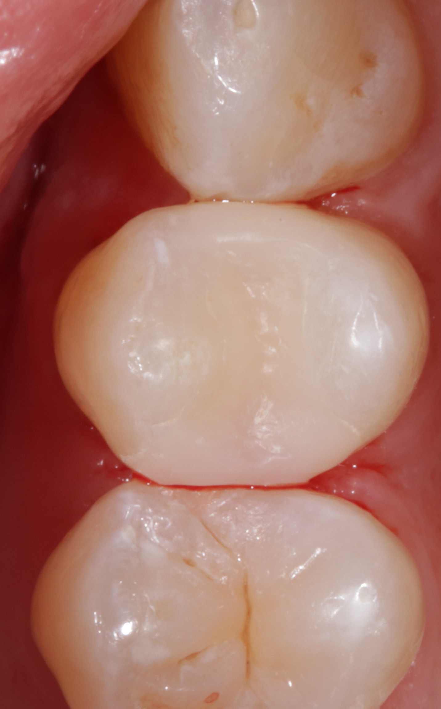 Composite filling after