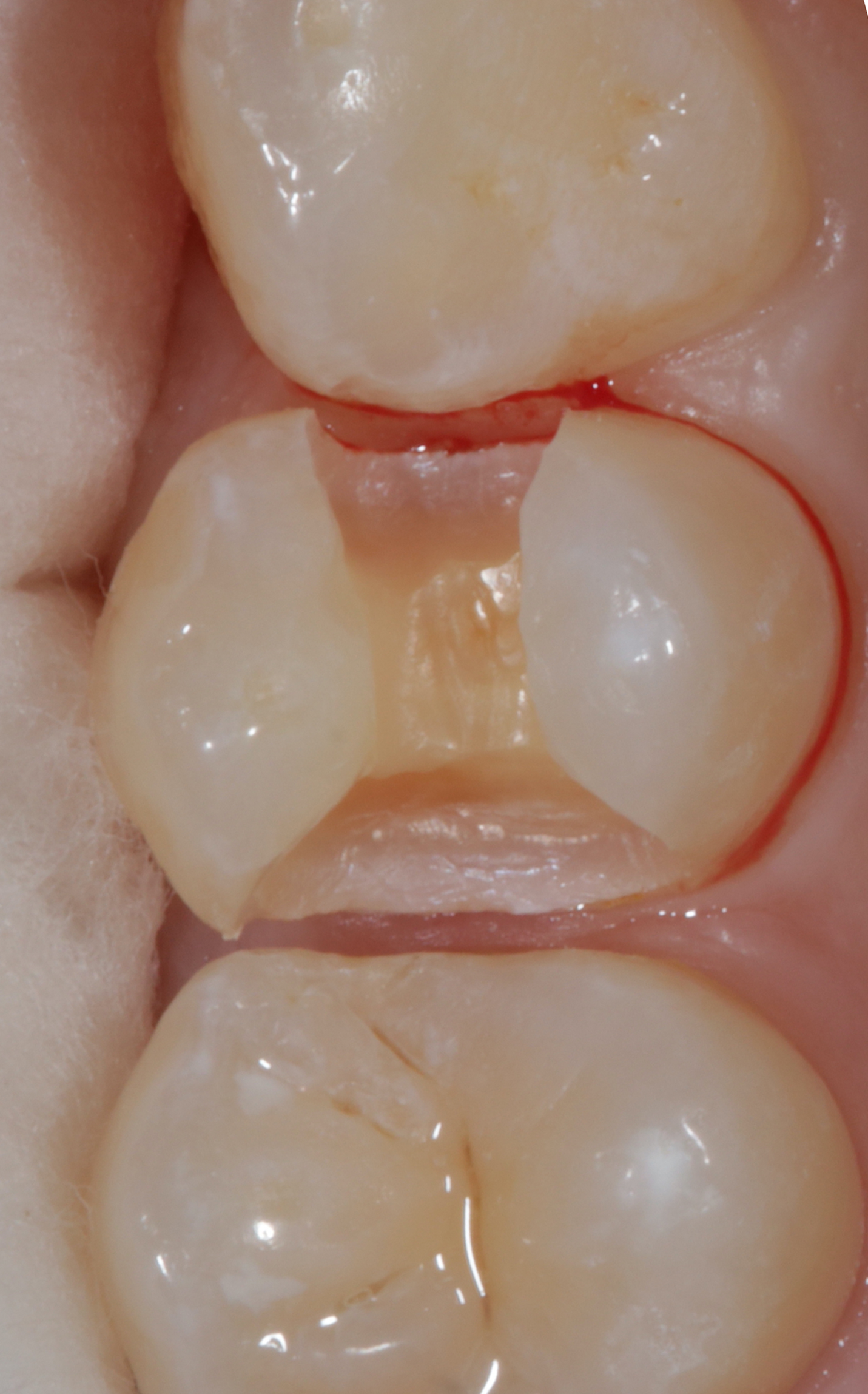 Composite filling before