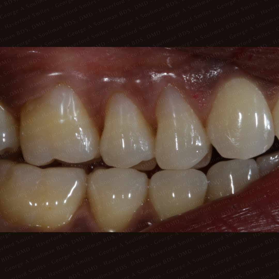 Composite bonding after