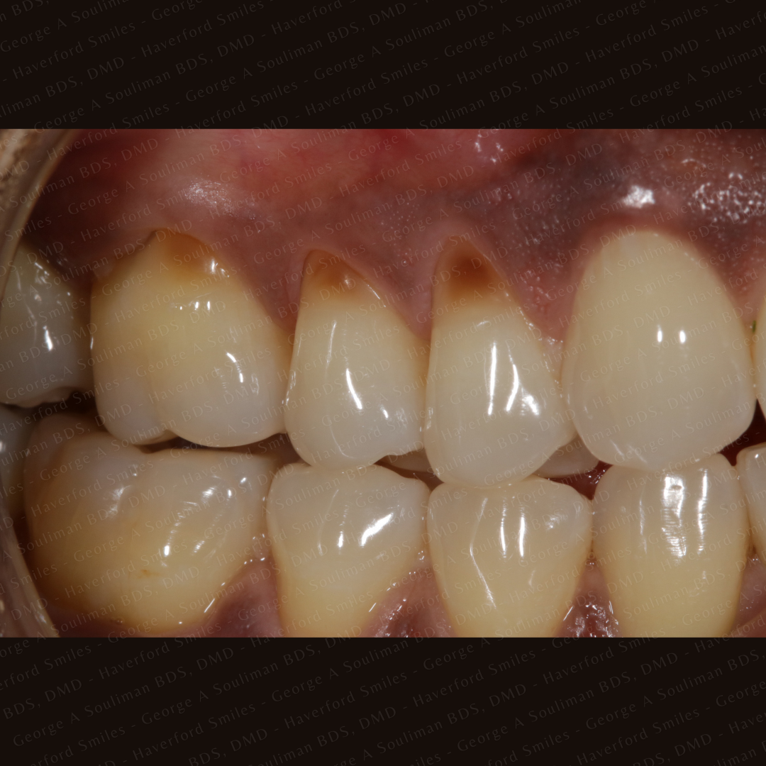 Composite bonding before