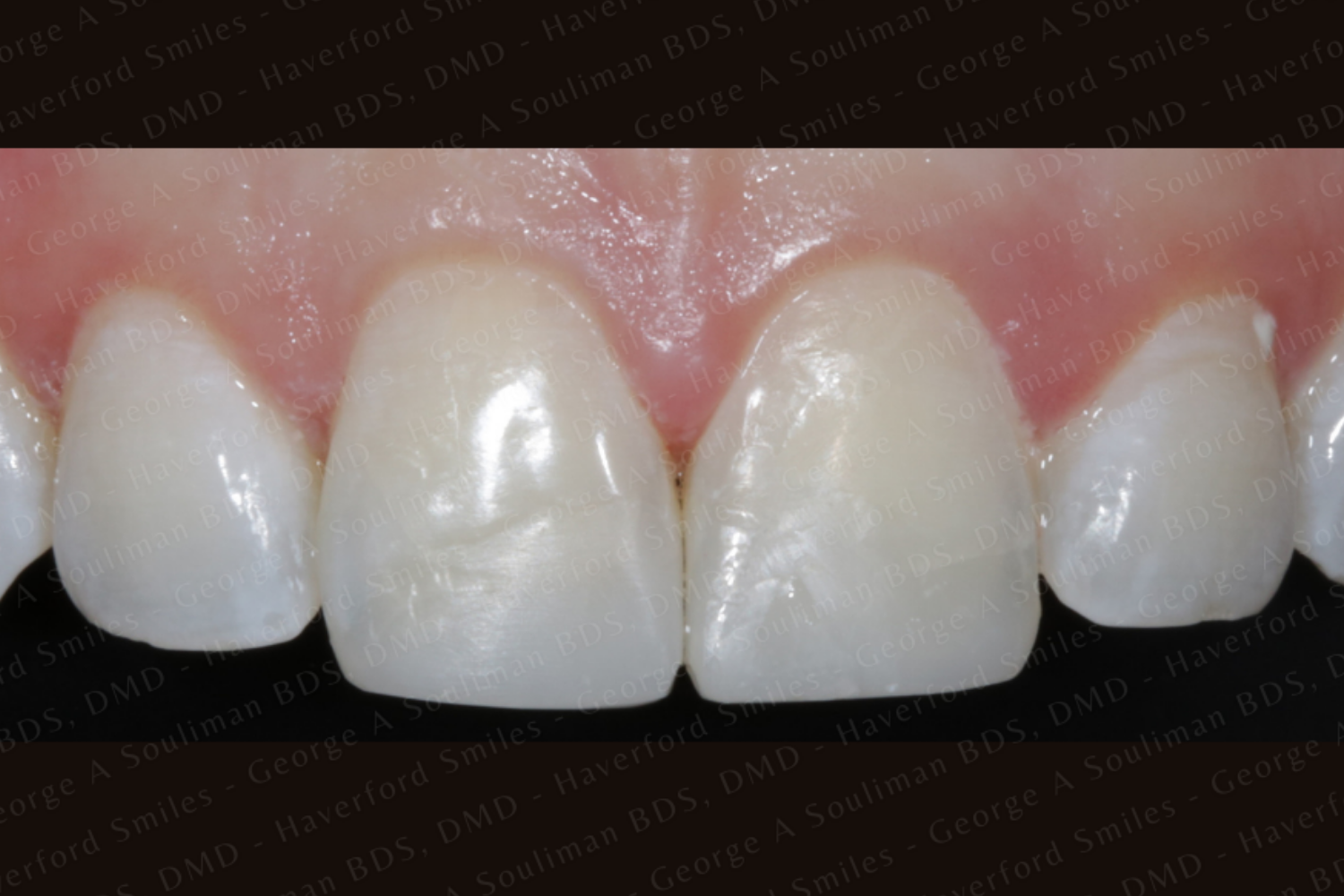 Front composite bonding after