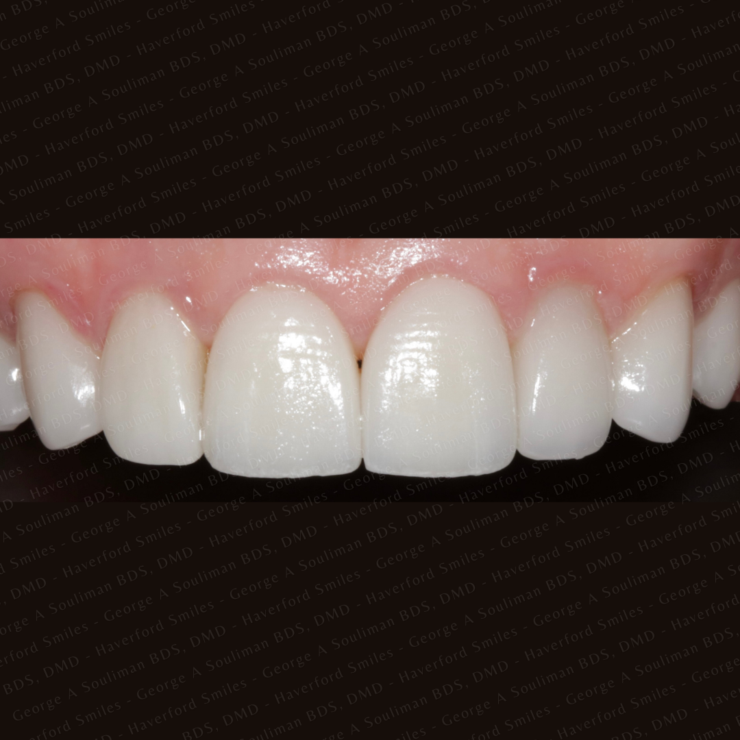 Front ceramic veneer after