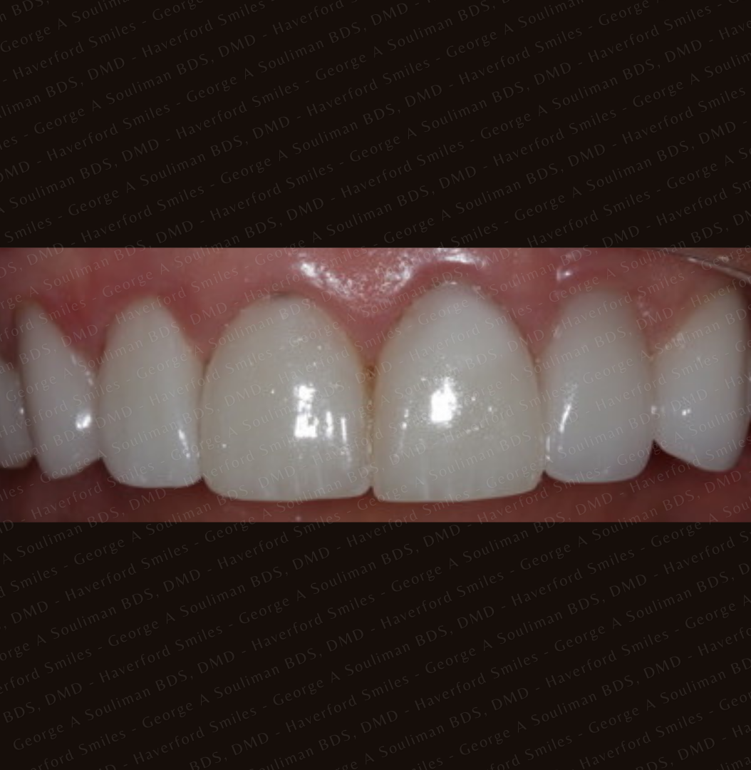 Front ceramic veneer before