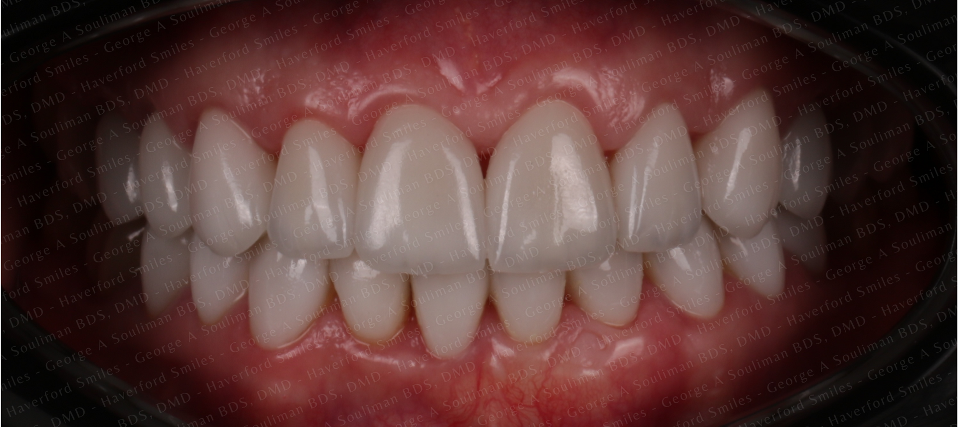 Full mouth rehab Ceramic Veneers & Ceramic Crowns after