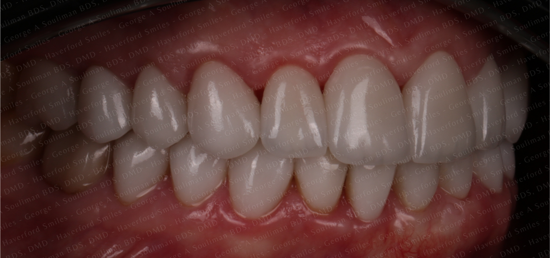 Full mouth rehab Ceramic Veneers & Ceramic Crowns after