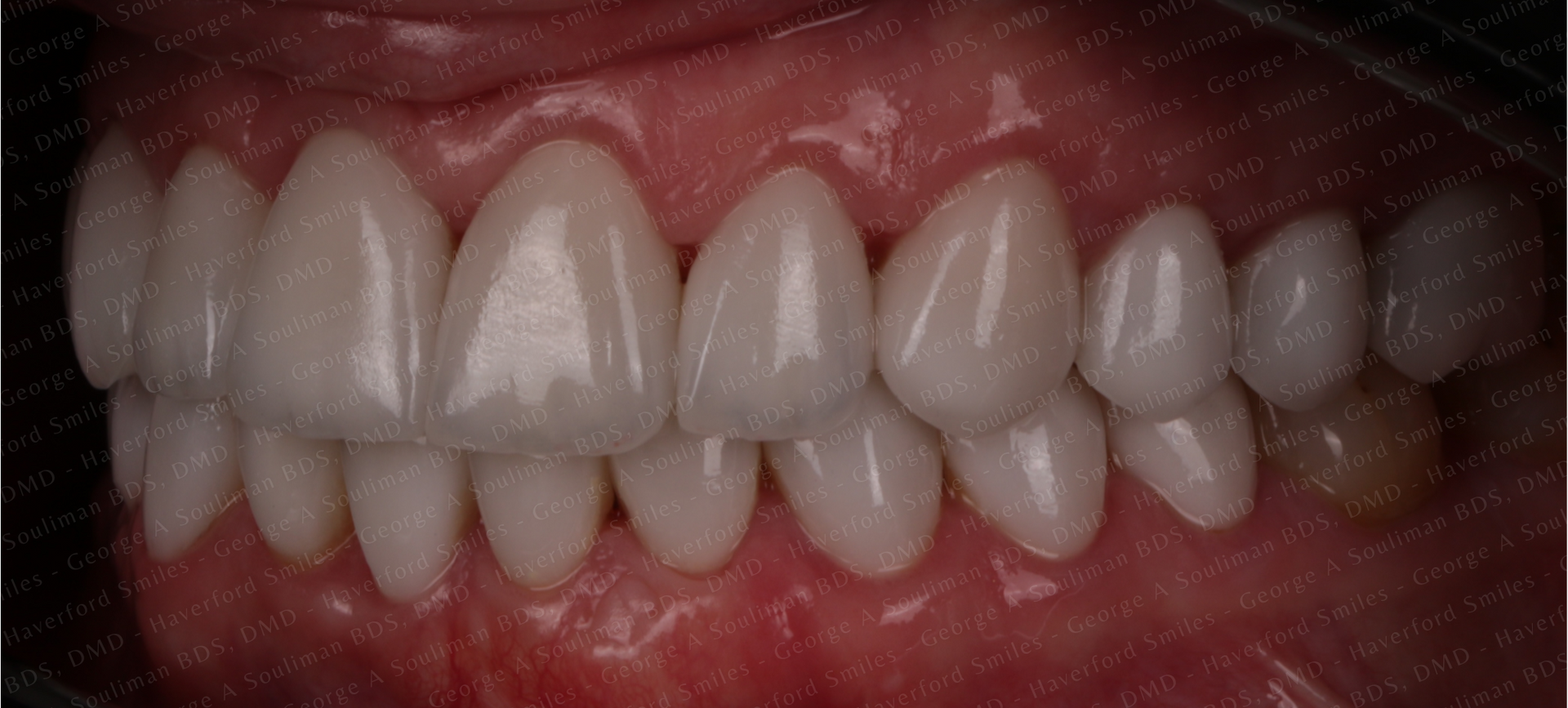 Full mouth rehab Ceramic Veneers & Ceramic Crowns after