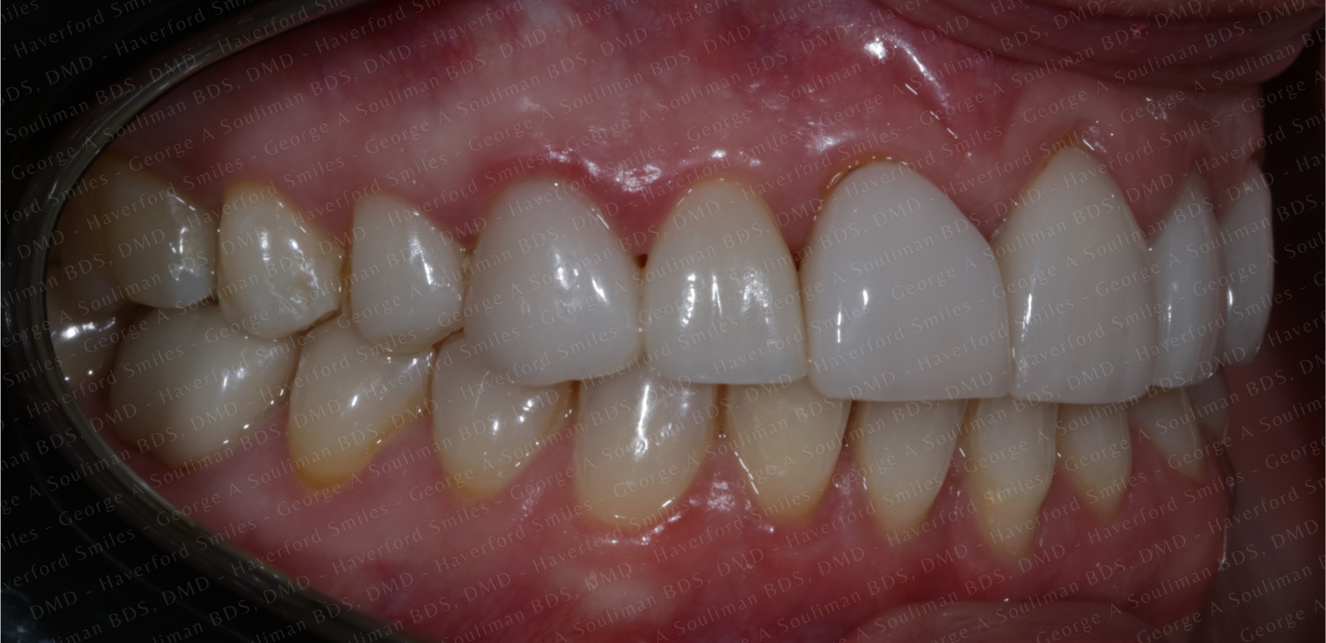 Full mouth rehab Ceramic Veneers & Ceramic Crowns before