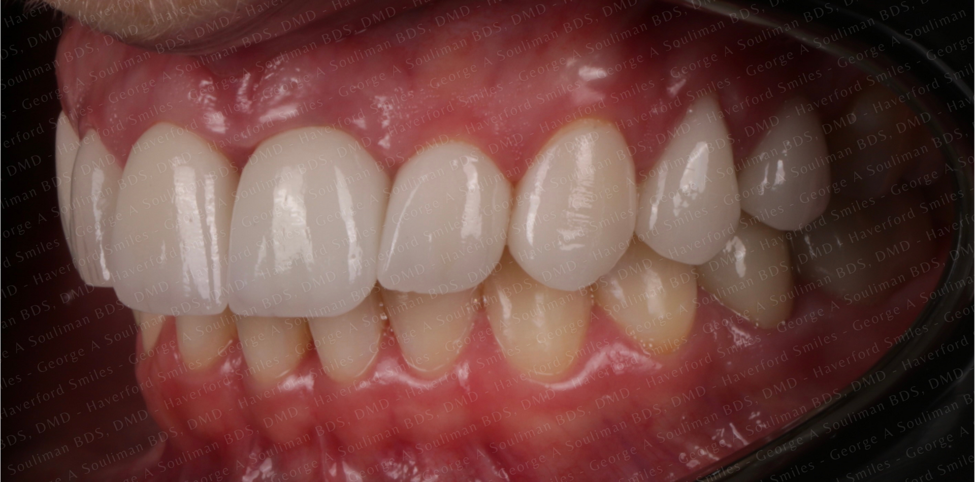 Full mouth rehab Ceramic Veneers, Ceramic Crowns & Ceramic Bridge after