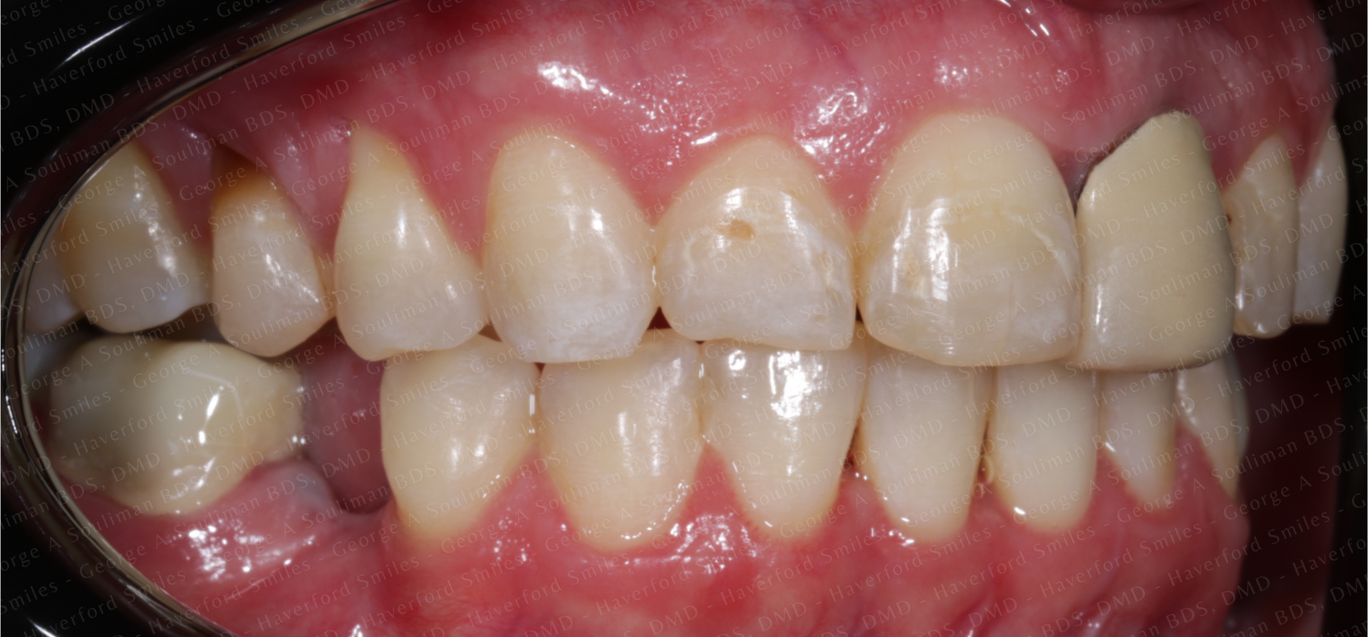 Full mouth rehab Ceramic Veneers, Ceramic Crowns & Ceramic Bridge before