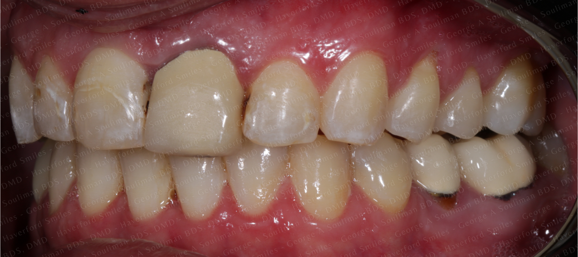Full mouth rehab Ceramic Veneers, Ceramic Crowns & Ceramic Bridge before