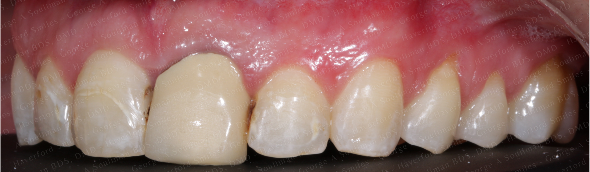 Full mouth rehab Ceramic Veneers, Ceramic Crowns & Ceramic Bridge before