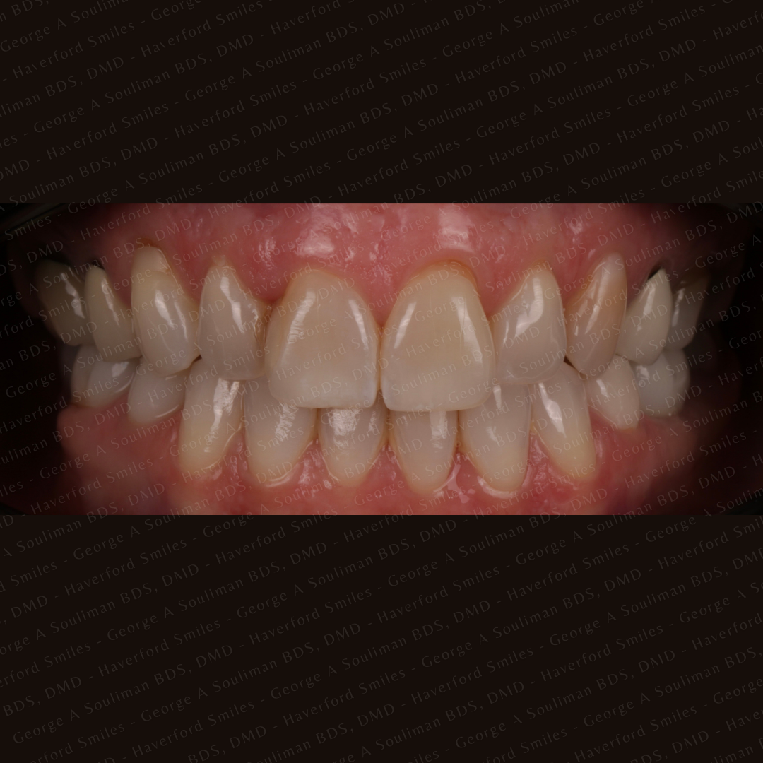 Full mouth rehab Ceramic Veneers, Implants & Ceramic crowns before